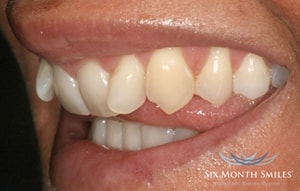 Six Month Smiles Cosmetic Braces - Before