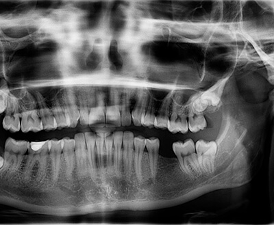 Xray with Missing Teeth