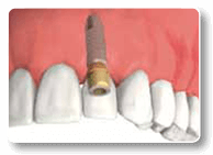 Ruckersville Dental Implants