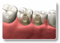 Dental Implantation in Ruckersville