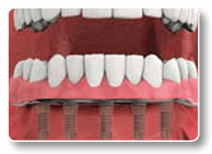 Fixed Dental Implant-Supported
