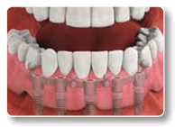 Removable Dental Implant-Supported