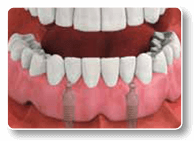 Dental Implant-Stabilized