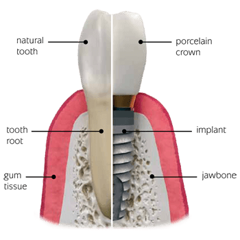 Ruckersville Dental Implants