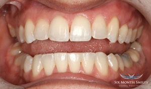 Six Month Smiles Cosmetic Braces - After