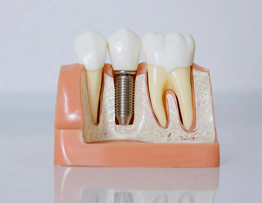 Could Dental Implants Be Right for You?