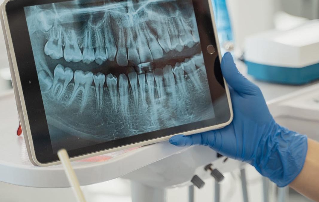 Be Wise About Wisdom Teeth